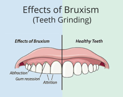 Effects of Bruxism (teeth grinding)