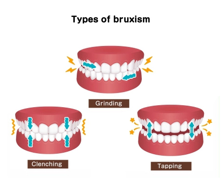 Types of bruxism Tanner and Michigan splints prevent damage to teeth and jaw joints 